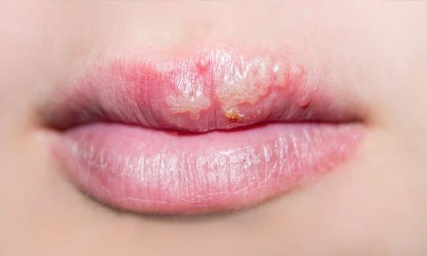 herpes labiale sintomi e cura dell'infezione 
