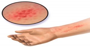 eczema, che cos'è cause e rimedi naturali