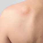 rigonfiamento della pelle