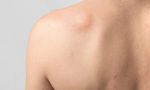 rigonfiamento della pelle causato da un lipoma, quali sono i sintomi