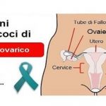 Cancro dell’Ovaio
