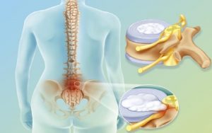 Qual è la Differenza tra l’Ernia del Disco ed il Mal di Schiena?