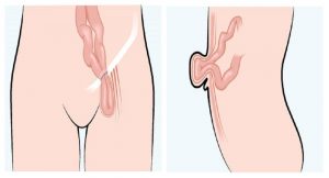 L’ernia addominale