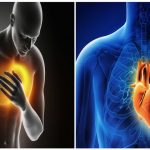 infarto