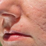 disintossicare la pelle